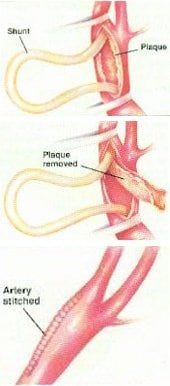 carotid endartectomy artery